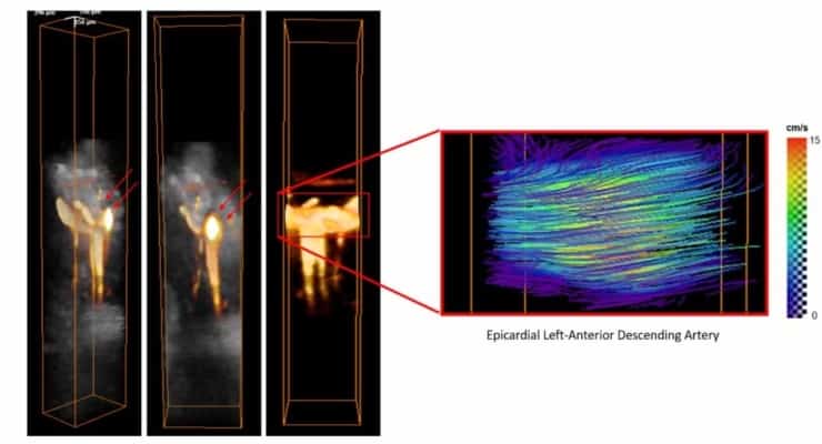 3D ultrafast ultrasound quantifies coronary blood flow – Physics World