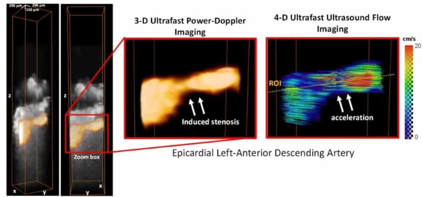 3D ultrafast ultrasound quantifies coronary blood flow – Physics World
