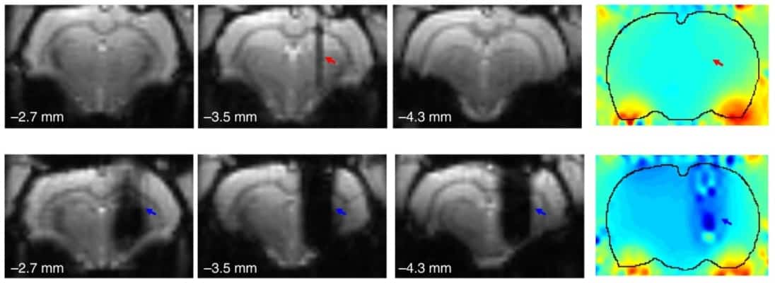 Graphene electrodes enable functional MRI during deep brain stimulation ...
