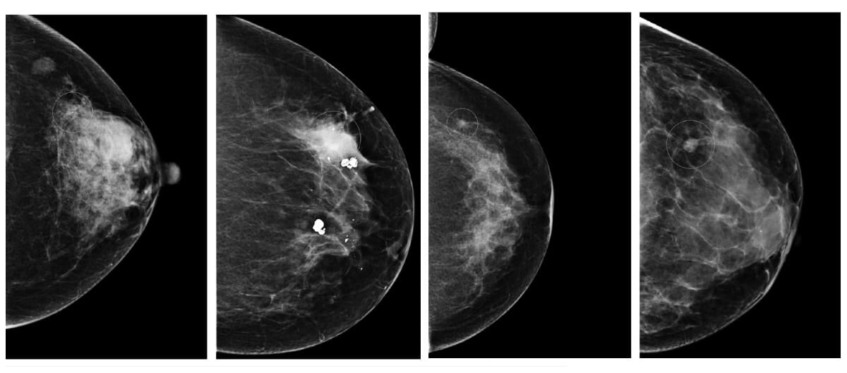 AI rivals human radiologists at breast-cancer detection â€“ Physics World - Medical Physics Web