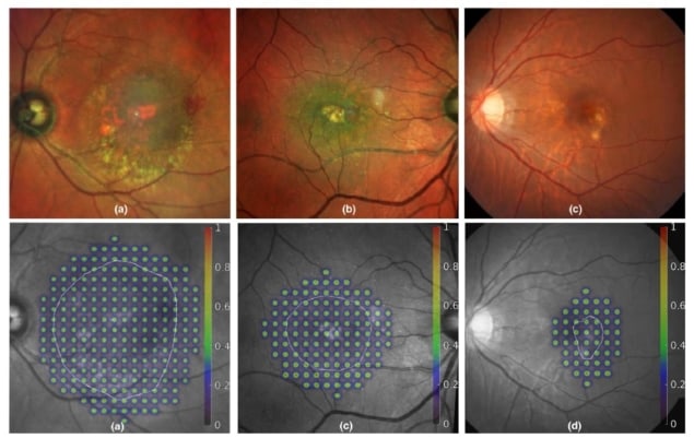 Grid therapy of AMD lesions