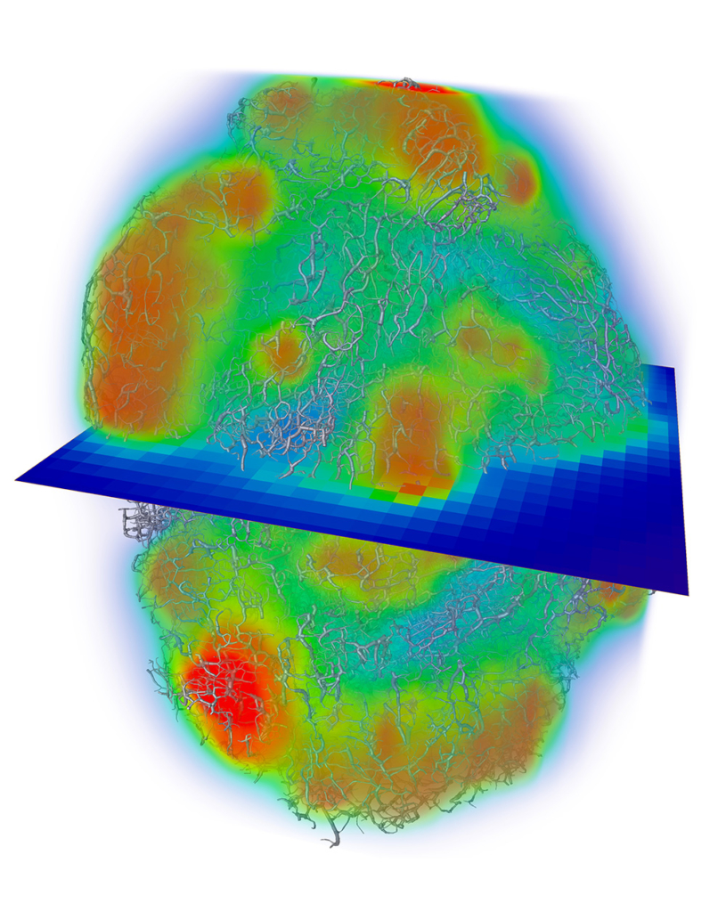 How computational modelling is transforming medicine – Physics World