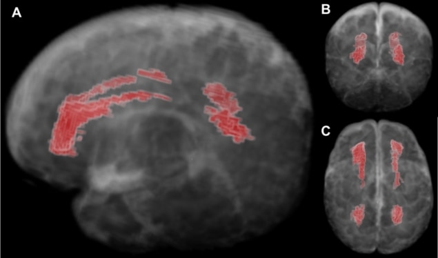 MRI biomarker