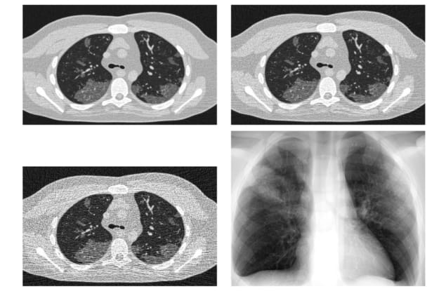 Virtual imaging trials aim to optimize COVID-19 screening – Physics World