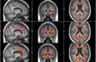 Probability maps of white matter hyperintensities