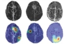 LVO detection