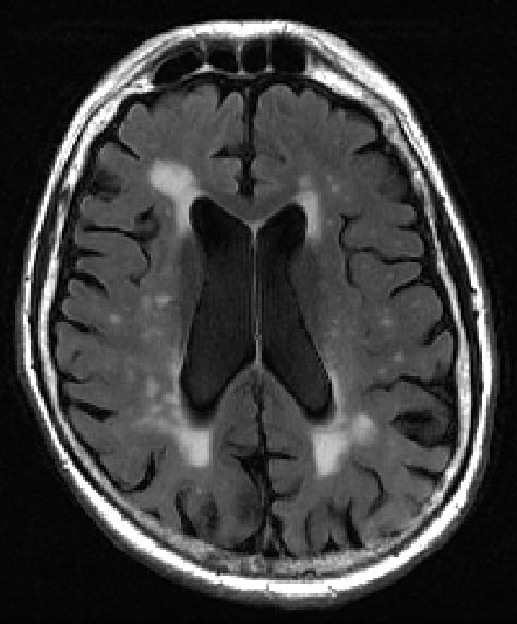 Lesion mapping tool makes early signs of dementia easier to spot