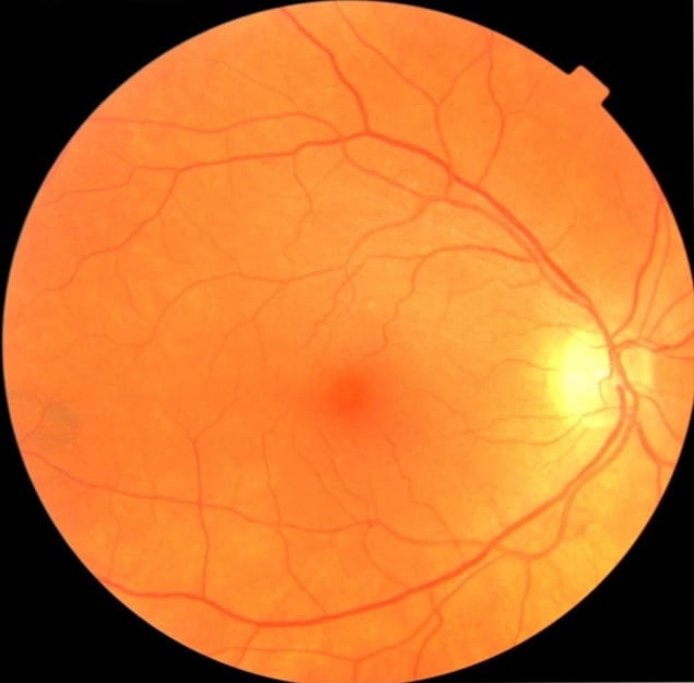 Fundus eye image