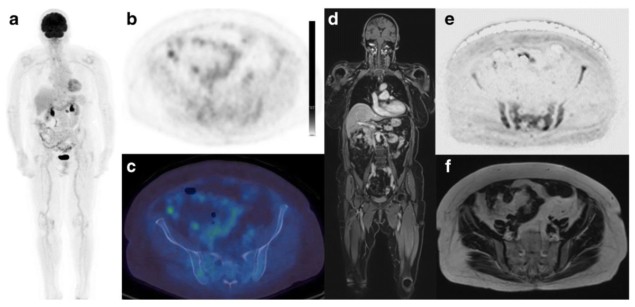 PET/CT and whole-body MRI