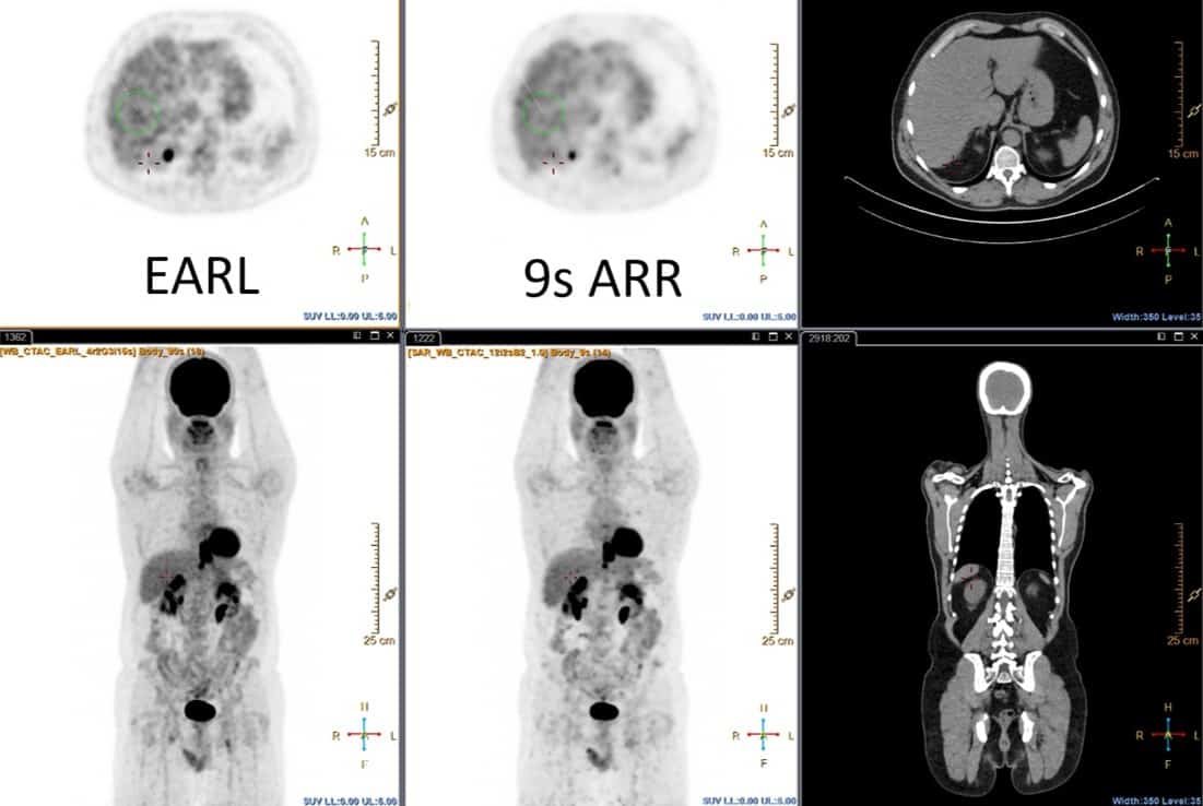 Ultrafast low-dose PET scans will benefit cancer Physics World