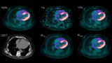 De-noising PET scans