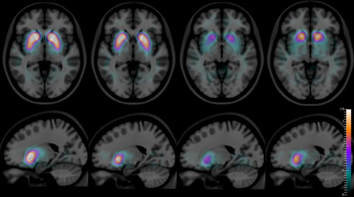 Understanding Different Types of Dementia