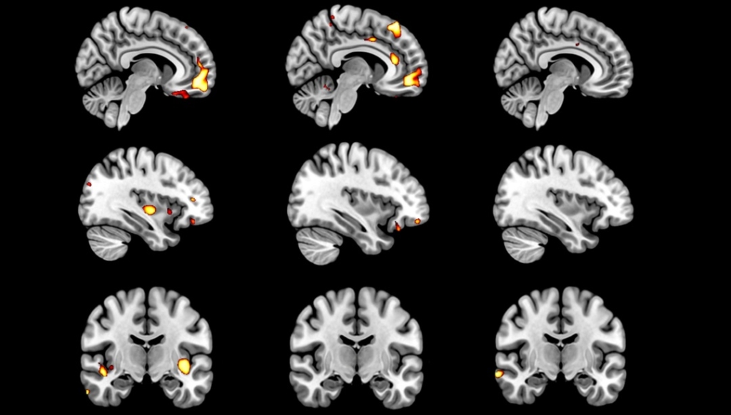 Single MRI scan of the brain could detect Alzheimer’s disease – Physics ...