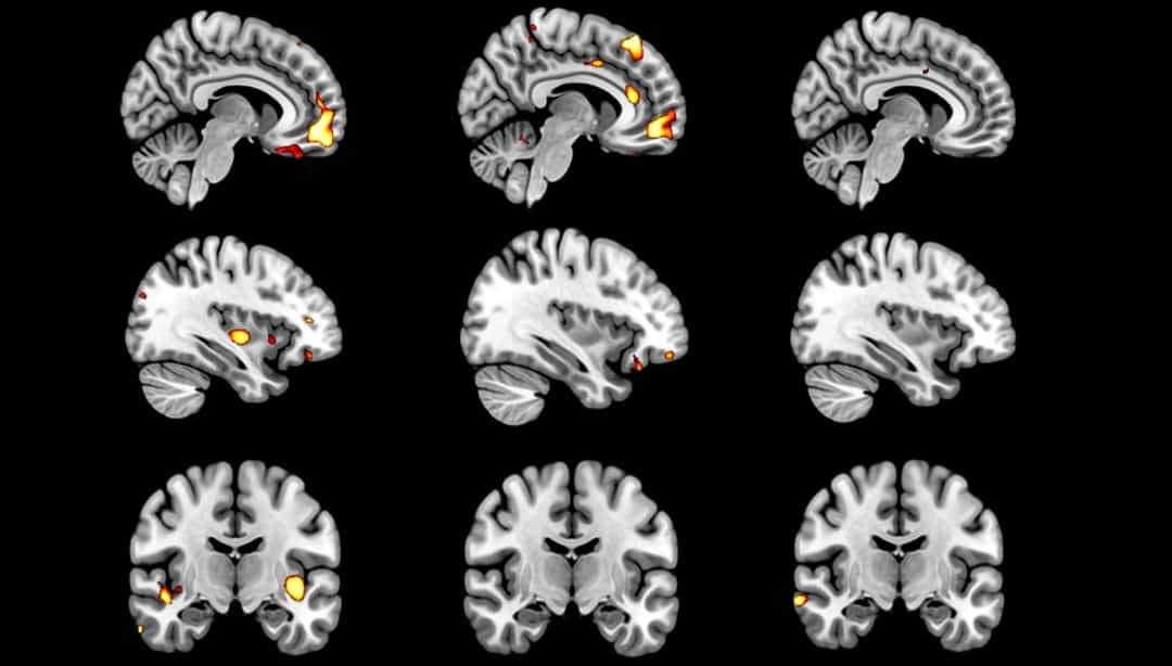 Image: MRI reveals deterioration of brain's reward circuitry in younger-onset dementia