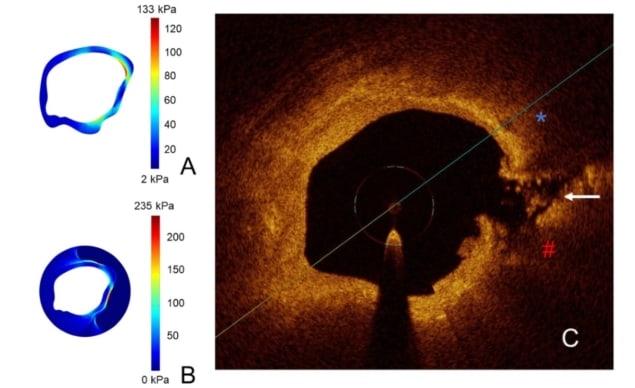 Predicting plaque rupture