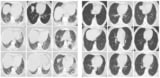 Sample lung CT scans