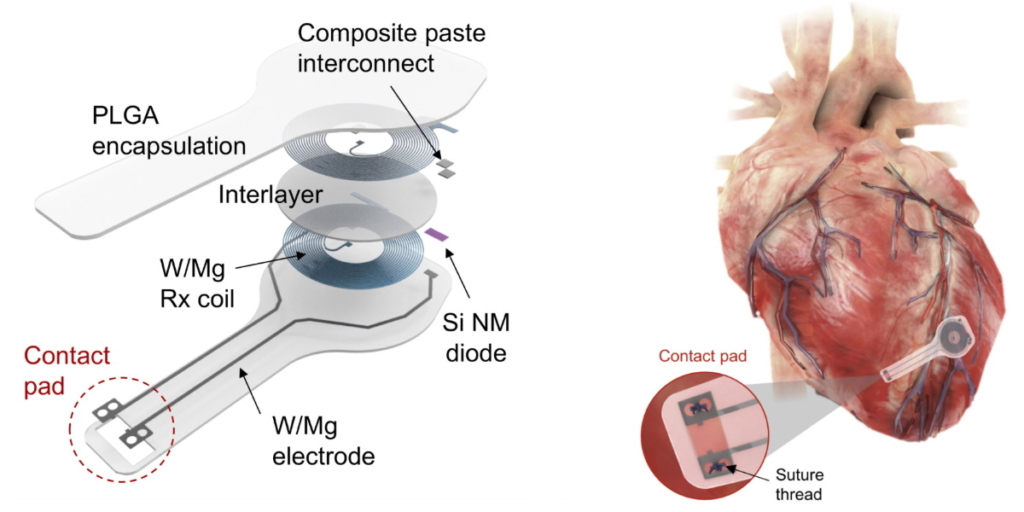 Heart Pacemaker Design Temporary pacemaker regulates heart rhythm then completely disappears ...