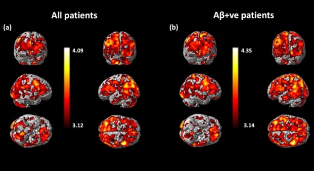 Novel PET Tracer Sheds Light On Plaque Formation In Alzheimer's Disease ...