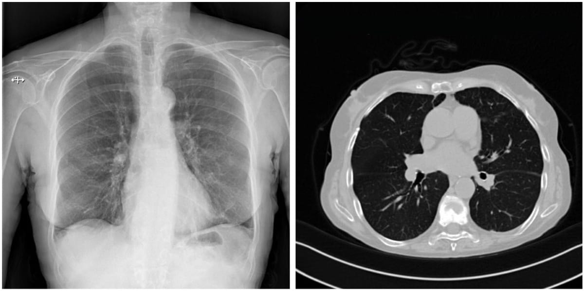 Estimating patient size from X-ray data improves radiation risk ...