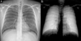 Attenuation-based and dark-field radiographs