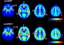 Hyperbaric oxygen therapy increases cerebral blood flow