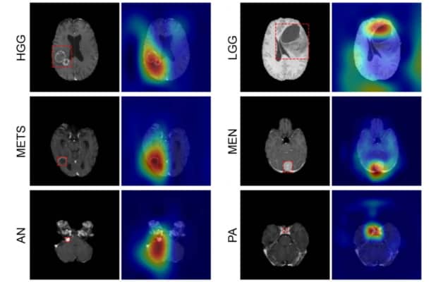 Deep Learning Model Automates Brain Tumour Classification – Physics World