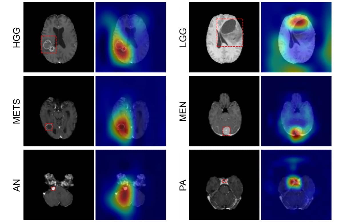 Deep Learning automating brain tumour classification 1