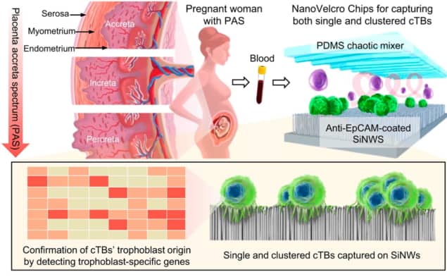 Detecting placenta accreta spectrum using a NanoVelcro Chip