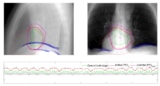 Motion tracking during radioablation