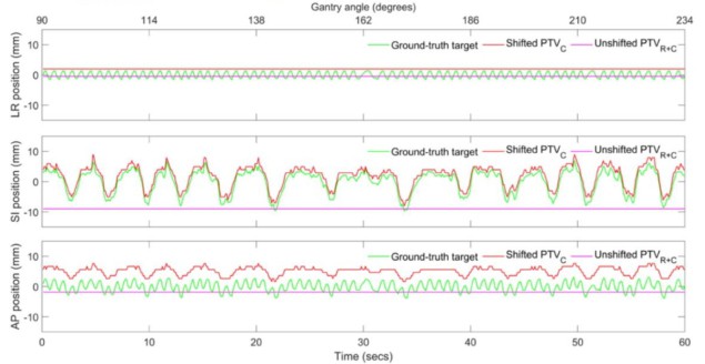 Motion tracking during radioablation