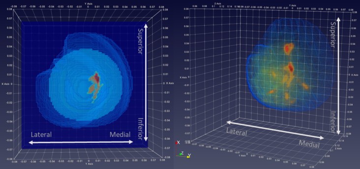 Wavelia microwave breast imaging
