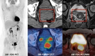 PET/MRI for staging cervical cancer