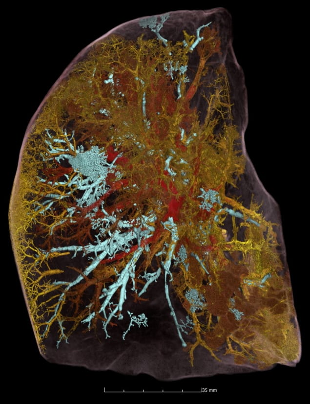 COVID-19-related lung damage