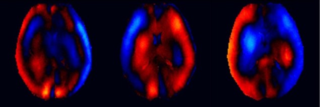 MRE images of a brain