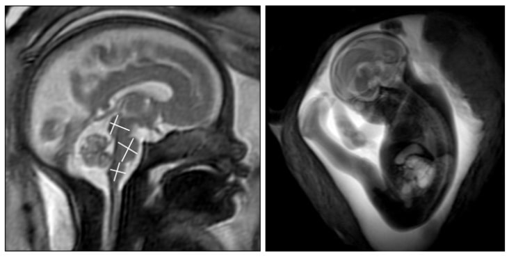Foetal MRI