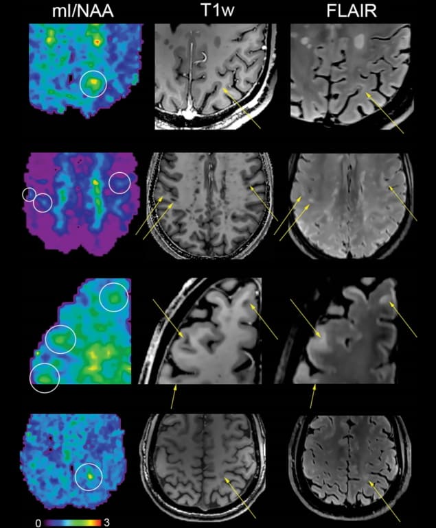 Imaging multiple sclerosis patients