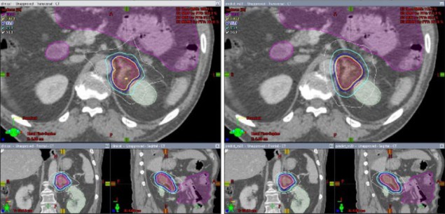 Radiotherapy plan comparisons