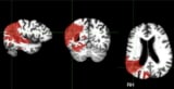 Stroke lesions