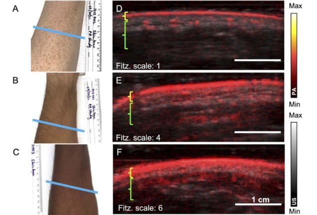 Photoacoustic imaging