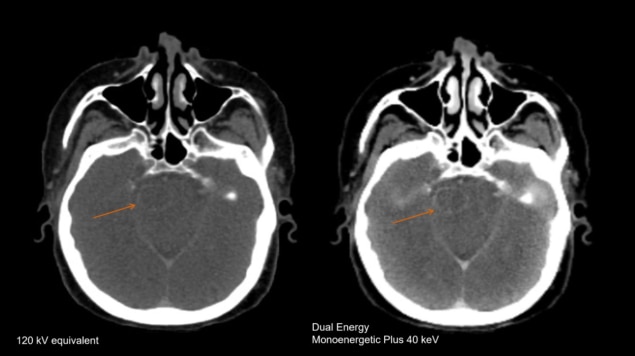 Brain CT images