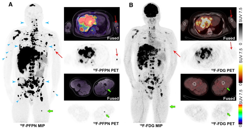 Melanin-targeted PET probe tracks down malignant melanoma lesions ...