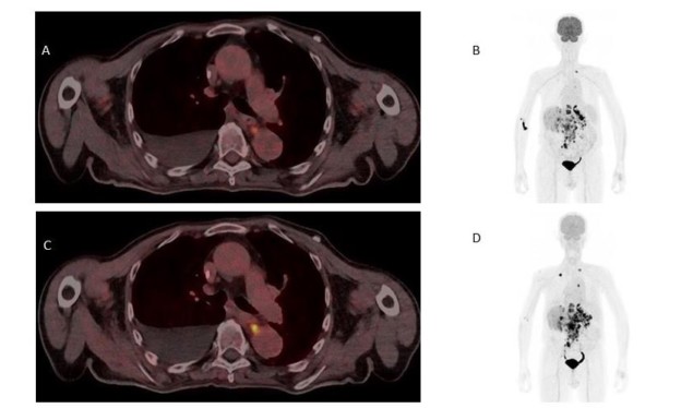 Two radiotracers work better than one for cancer imaging – Physics World