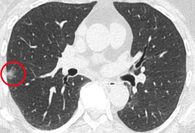 Tumour detection