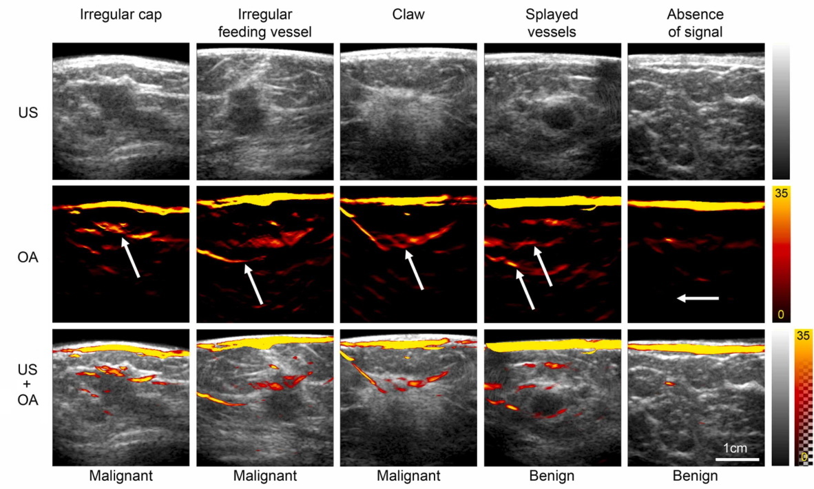 Basics of Breast Ultrasound - Radiology