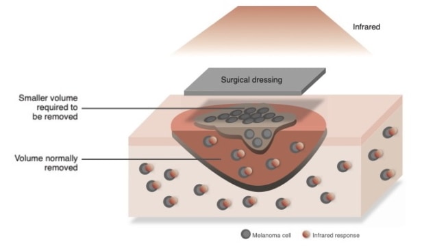 Photothermal surgical dressing