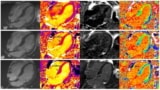 Cardiovascular MR with extracellular volume mapping