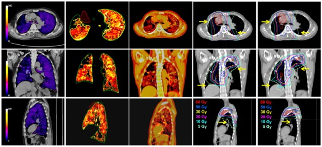 Lung cancer radiotherapy