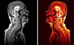 Spiegelbeelden van twee 3T MRI-scans