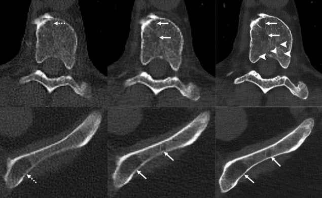 Lytic bone lesions in a multiple myeloma patient