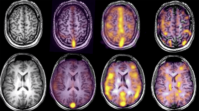 Deep learning speeds triage of brain scans – Physics World